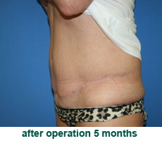 plastic-surgery-tummy-tuck